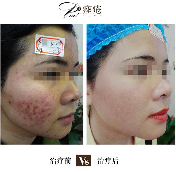 海口哪家治青春痘医院比较好？